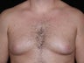 Male Breast Reduction