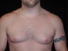 Male Breast Reduction