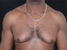 Male Breast Reduction