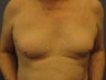 Gynecomastia, Male Breast Reduction