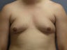 male breast reduction, gynecomastia