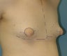 Gynecomastia