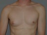 Male Breast Reduction