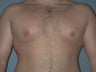 Gynecomastia, Male Breast Reduction