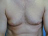 Gynecomastia, Male Breast Reduction