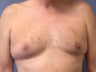 Gynecomastia, Male Breast Reduction