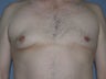 Gynecomastia, Male Breast Reduction