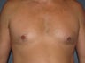 Gynecomastia, Male Breast Reduction