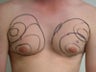 Gynecomastia, Male Breast Reduction