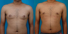 Male Breast Reduction