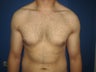 Male Breast Reduction