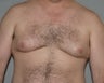 Gynecomastia