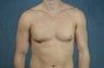 Male Breast Reduction