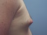 Male Breast Reduction