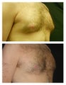 Gynecomastia