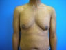 Male Breast Reduction