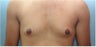 Gynecomastia