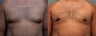 Gynecomastia (Male Breast Reduction)