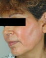 Melasma Treatment 