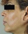 Melasma Treatment 