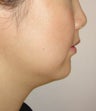 Mesotherapy for under chin