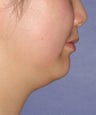 Mesotherapy for under chin