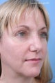 Fractional CO2 Laser Resurfacing