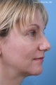 Fractional CO2 Laser Resurfacing 