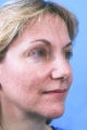 Fractional CO2 Laser Resurfacing