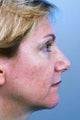 Fractional CO2 Laser Resurfacing 