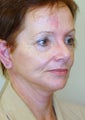 Mini Facelift and Necklift