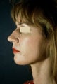 ActiveLift Facelift