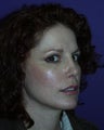 Mini Facelift, Eyelids, Cheek Lift and Lip Enhancement