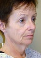 Mini Facelift and Necklift