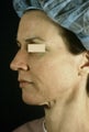 ActiveLift Facelift