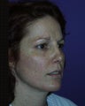 Mini Facelift, Eyelids, Cheek Lift and Lip Enhancement