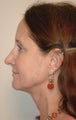 Mini Face Lift
