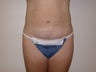Mini tummy tuck