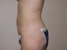 Mini tummy tuck