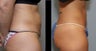 40 year old female- mini tummy tuck