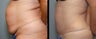 28 year old female- mini tummy tuck