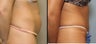 38 year old female with mini tummy tuck