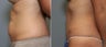 37 year old female with mini tummy tuck