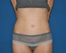 Mini-Abdominoplasty