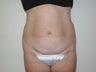 Mini tummy tuck