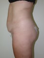 Mini tummy tuck