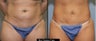 40 year old female- mini tummy tuck