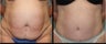 28 year old female- mini tummy tuck
