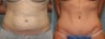 37 year old female with mini tummy tuck