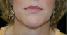 neck liposuction